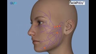 Understanding Facial Palsy [upl. by Newcomer]