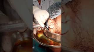 Arthrocentesis  TM Joint Lavage using Double Lumen needle technique [upl. by Airamalegna]