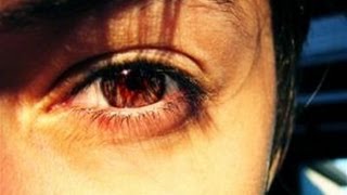 How To Understand The Symptoms Of Optic Neuritis [upl. by Inatirb97]