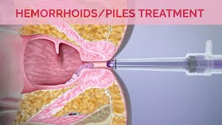 Hemorrhoids Removal Surgery I Hemorrhoid Treatment with Laser Surgery amp Rubber Band Ligation [upl. by Meldoh]