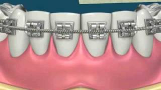 Uso del hilo dental con ortodoncia [upl. by Osswald]