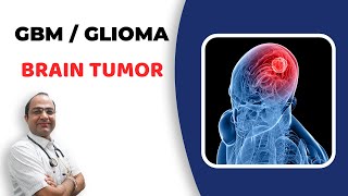 Glioma Brain Tumour Treatment  GlioblastomaGBM Cancer  दिमाग का कैंसर  Best Homeopathic Doctor [upl. by Elleryt]