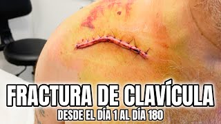 Fractura de Clavícula Operación de Clavícula Recuperación [upl. by Sanders556]