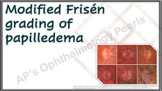 Modified Frisén Grading of Papilledema [upl. by Waxman]