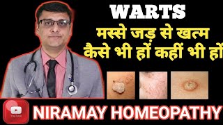 मस्से को जड़ से हटाने के उपाय  Home remedies for warts 100 effective [upl. by Ah212]