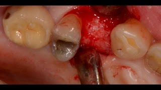 Periodontal Surgery and Dental Implant Upper Premolar [upl. by Medwin202]