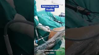 Artroscopia de rodilla y reconstrucción ligamento cruzadoanterior perforación de Túnel femoral [upl. by Amirak]