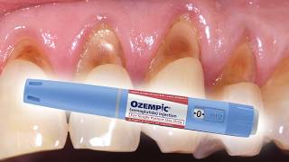 Is Ozempic Shrinking Both Your Waistline and Gumline [upl. by Fradin]