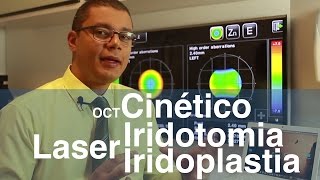 Combinação de lasers Iridotomia e Iridoplastia  OCT cinético do ângulo no glaucoma [upl. by Niowtna743]