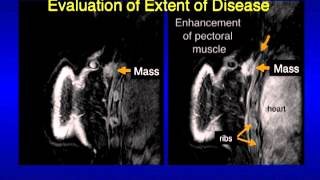 UCSF Radiology Mammography Images Revealing What Cancer Looks Like [upl. by Stutman]