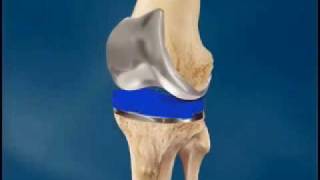 Total Knee Replacement Surgery Arthroplasty  University of Vermont Medical Center Vermont [upl. by Yrtsed]