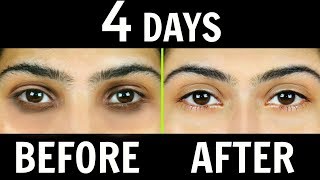 How to Remove Dark Circles Naturally in 4 Days 100 Results  Anaysa [upl. by Ailimac]