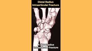 Distal Radius Intraarticular Fracture [upl. by Lawtun]