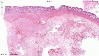 Gastrointestinal Stromal Tumor GIST  Histopathology [upl. by Kere]