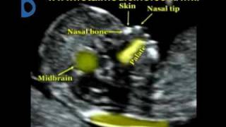 Fetal Medicine Foundation  Nuchal translucency [upl. by Lordan]