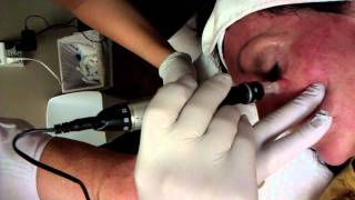 Dermapen Under The Eye Treatment  Micro Skin Needling [upl. by Mungo]