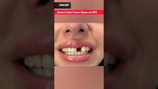 Avulsed Central Incisor Replace via Removable Denture  My Queen song shorts dentist rpd viral [upl. by Dunning]