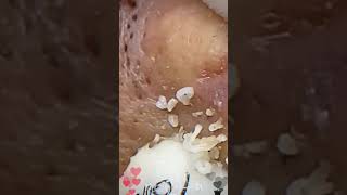 Skincare  Blackheads Removal 095 skincare skincare blackheads blackheads [upl. by Kama424]