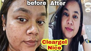 Acne के लिए Best Medicine  Cleargel nico  I used clindamycin and nicotinamide for my hormonal Acne [upl. by Assili]