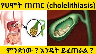 የሀሞት ጠጠር cholelithiasis ምንድነው  እንዴት ይፈጠራል ፣ ምልክቶቹ እና ህክምናው [upl. by Eolc]