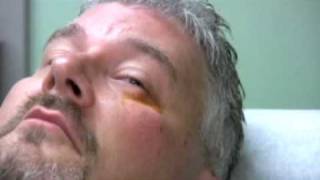 Chalazion Injection Demonstration [upl. by Hardie629]