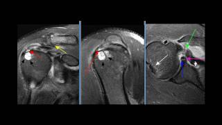 Shoulder MRI Case 3 [upl. by Oliana]