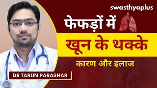 पल्मोनरी एम्बोलिज्म फेफड़ों में रक्त का थक्का  Pulmonary Embolism in Hindi  Dr Tarun Parashar [upl. by Nahtannoj]