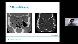 Rhinosinusitis EPOS 2020 Update [upl. by Aihsatal]