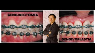 Gengivectomia Gengivoplastia dicas práticas para dentistas raspagem gengival periodontia [upl. by Farhsa282]