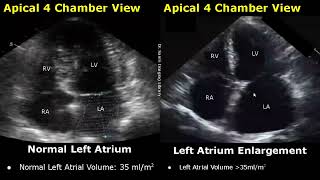 Echocardiography Normal Vs Abnormal Images  Heart Ultrasound  Cardiac ColorSpectral Doppler USG [upl. by Rayburn]