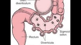 Top 3 Ways To Prevent Diverticulitis Attacks [upl. by Wilmer]