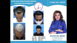 ALIFF AZIZ MALAYSIAN SINGER FUE HAIR TRANSPLANT [upl. by Joshi491]