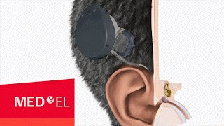 The RONDO cochlear implant from MEDEL  2D  INT [upl. by Ressay]