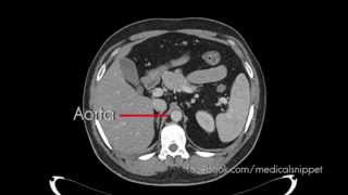 Branches of Abdominal Aorta [upl. by Alaet]