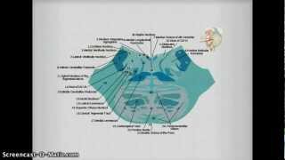 Medial Inferior Pontine Syndrome pics [upl. by Lee]