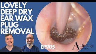 PERFORATED EARDRUM amp TOUGH DRY DEEP EAR WAX REMOVAL  EP847 [upl. by Grayce]