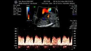 ductus venosus doppler [upl. by Ritch]