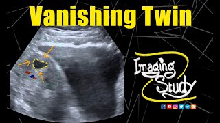 Vanishing Twin  Ultrasound  Case 142 [upl. by Bensen205]