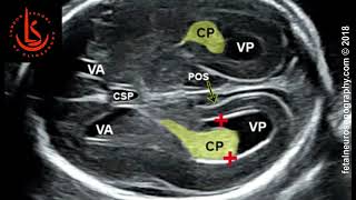 Fetal lateral ventricle measurements How to measure posterior ventricle for ventriculomegaly [upl. by Hildie189]