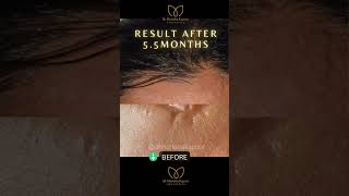 Permanent Scar Removal Treatment Your Path to Freedom from SelfConsciousness shorts trending [upl. by Tades857]