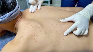 ACNE TREATMENT VU QUYNH MI Acne On Mans Back 2024 [upl. by Cirtemed809]