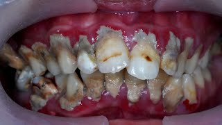 25yo MALE  TARTAR INVASION  SCALING  Dentist  Dokter Gigi Tri Putra [upl. by Coonan691]