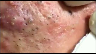 Benefits of Skin Cleansing Blackhead Skin [upl. by Etteyafal467]