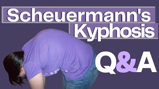 Common Questions About Scheuermanns Kyphosis [upl. by Euqina]