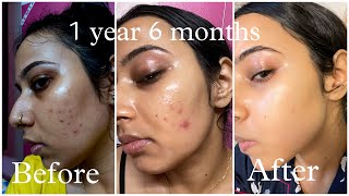 Pimples Removal Journey  Tretinoin before and after  all unfiltered photos and videos [upl. by Giselbert]