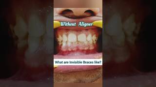 Invisible Braces be like this Clear Aligners for Teeth spacing Dr Srishti Bhatia smile braces [upl. by Bael]