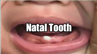 Natal Tooth  Baby born with a Tooth  Newborns  Neonatology  Doctor Xydi [upl. by Arvo]