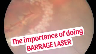 Importance of doing Barrage laser [upl. by Endor]