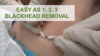 Easy as 1 2 3 Blackhead Removal  Dr Derm [upl. by Munniks901]