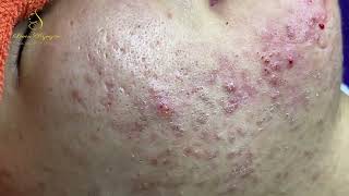 Loan Nguyen Acne Treatment 15677 [upl. by Otrebile]